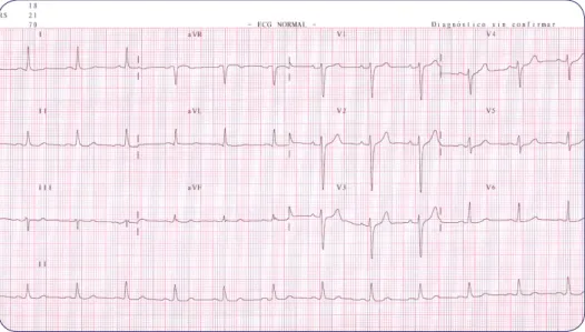 Figura 4. ECG Acceda a los vídeos