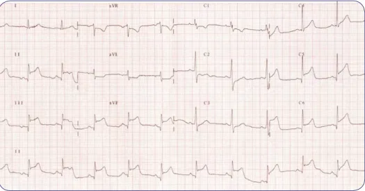 Figura 1. ECG