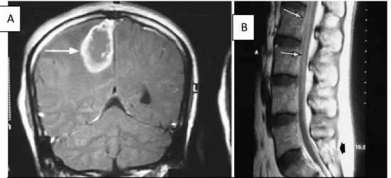 Figura 2. A) Tuberculoma. B) Afectación medular por tuberculosis. 
