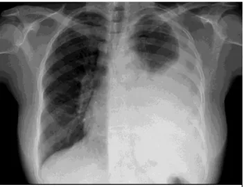 Figura  4. Derrame pleural unilateral. 