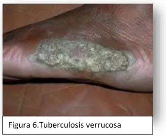Figura 6.Tuberculosis verrucosa 
