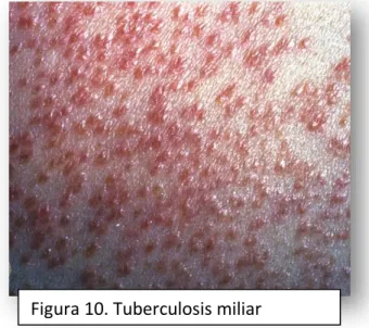 Figura 10. Tuberculosis miliar  cutánea. 