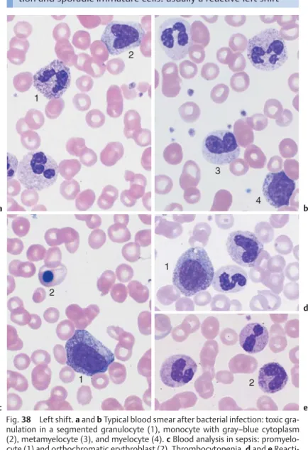 Fig. 38 Left shift. a and b Typical blood smear after bacterial infection: toxic gra- gra-nulation in a segmented granulocyte (1), monocyte with gray–blue cytoplasm (2), metamyelocyte (3), and myelocyte (4)