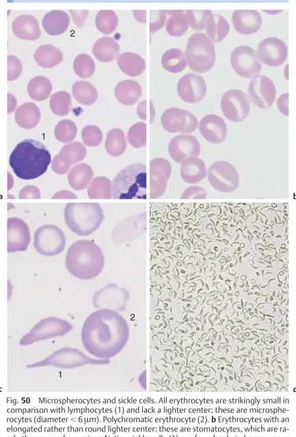Fig. 50 Microspherocytes and sickle cells. All erythrocytes are strikingly small in comparison with lymphocytes (1) and lack a lighter center: these are  microsphe-rocytes (diameter !6 µ m)