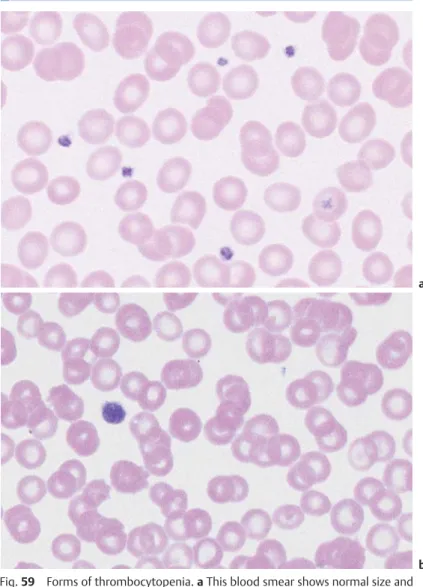 Fig. 59 Forms of thrombocytopenia. a This blood smear shows normal size and density of thrombocytes