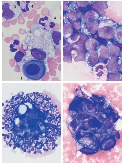 Fig. 67 Pleural effusion and ascites. a Pleural cytology, nonspecific exudate: dor- dor-mant mesothelial cell (or serosal cover cell) (1), phagocytic macrophage with  vac-uoles (2), and monocytes (3), in addition to segmented neutrophilic granulocytes (4)