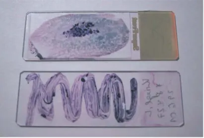 Fig. 6 Squash preparation and meandering smear for the cytological analysis of bone marrow spicules