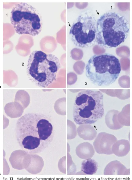 Fig. 13 Variations of segmented neutrophilic granulocytes. a Reactive state with toxic granulation of the neutrophilic granulocytes, more visibly expressed in the cell on the left (1) than the cell on the right (2) (compare with nonactivated cells, p