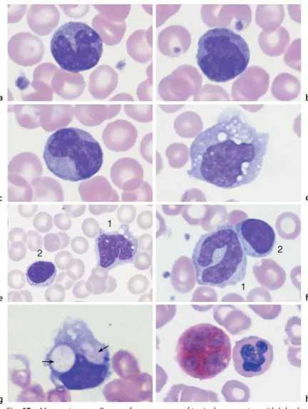 Fig. 15 Monocytes. a–c Range of appearances of typical monocytes with lobed, nucleus, gray–blue stained cytoplasm and fine granulation