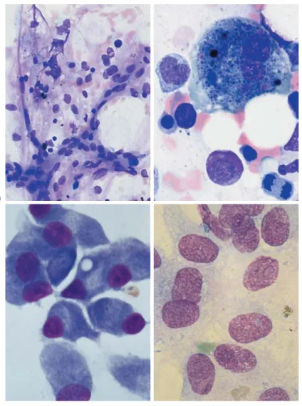 Fig. 20 Bone marrow stroma. a Spindle-shaped fibroblasts form the structural framework of the bone marrow (shown here: aplastic hematopoiesis after  ther-apy for multiple myeloma)