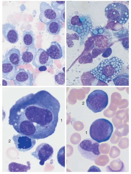 Fig. 28 Atypical cells in multiple myeloma. a Extensive infiltration of the bone marrow by loosely structured, slightly dedifferentiated plasma cells with wide  cy-toplasm in multiple myeloma