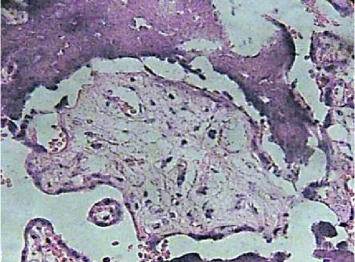 Fig. 8. Debris of immature intermediate villi can be seen associate with areas of calcification