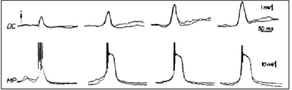 Figure 1. Simultaneous macroscopic corticogram (DC) and intracellular recording of a cortical neuron (MP) during experimentally  induced epileptic activity (TZ topic application to exposed cat´s cortex)