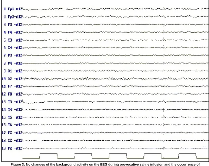 Figure 3: No changes of the background activity on the EEG during provocative saline infusion and the occurrence of  pseudoseizures.