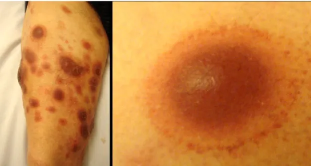 Figure 1: Multiple round pinkish and purple, targetoid-like, crusted plaques and nodules in limbs.