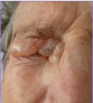 Figure 2: Eyelid swollen with crepitus on palpation.