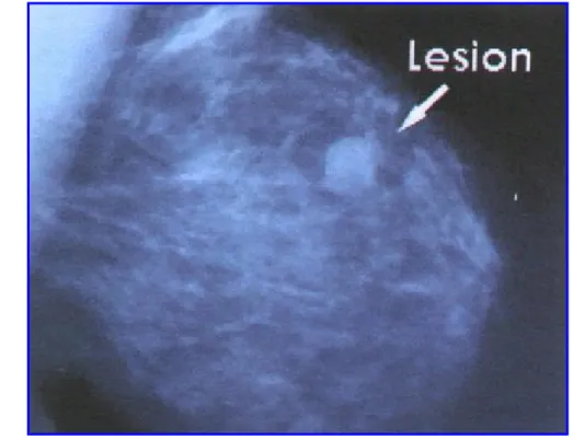 Fig 1.- Lesión sospechosa de carcimona de mama