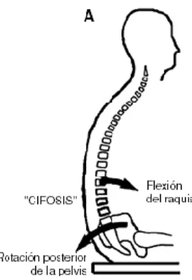 Figura 5 Postura cifótica. Fuente: https://bit.ly/2UQOl9D 