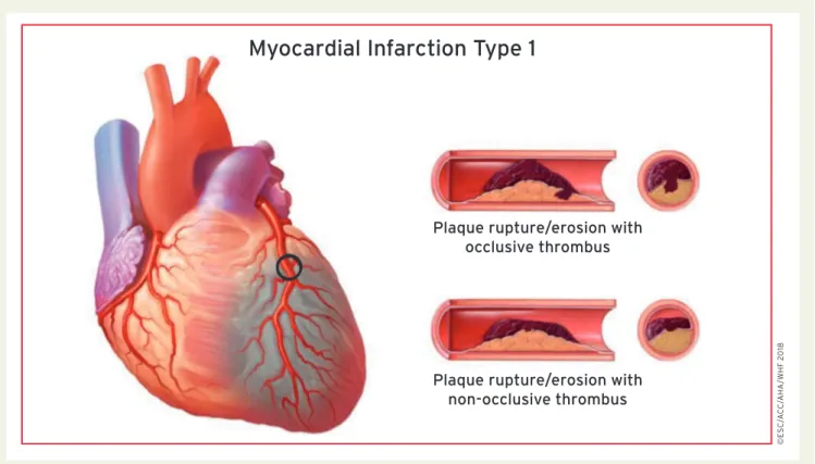 Figure 3 Myocardial infarction type 1.