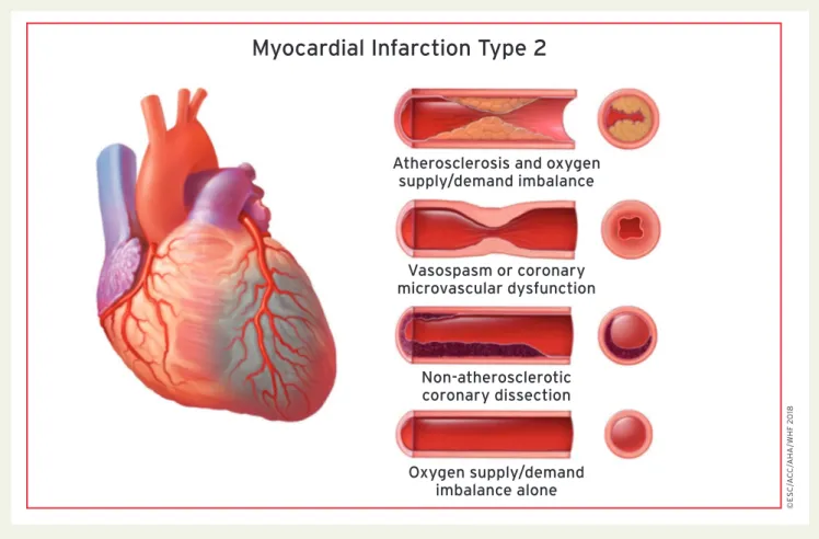 Figure 4 Myocardial infarction type 2.