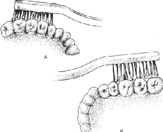 Figura  6.  Colocación  correcta  del  cepillo.  B.  Colocación  incorrecta  porque  las  puntas  del  cepillo comprimen a los dientes pero no pasan por los espacios interproximales