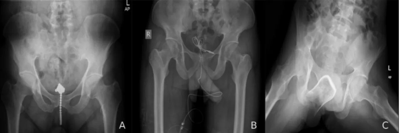 Figure 2.4: Examples of foreign objects in the pelvis. A) Plain radiograph of the pelvis showing a dense metallic foreign body that was composed of many small magnetic balls in the pelvic region, of which one part was a cloddy body in the bladder and the o