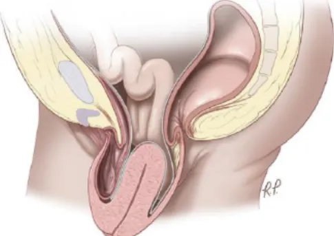 Figura 9: Rectocele. Compartiment  posterior (8)