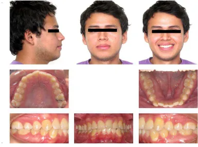 Fig. 7 Fotos intra y extraorales tomadas al inicio del estudio en un paciente con brackets 