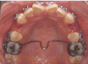 Fig. 11 Foto intraoral, ejemplo de aparato Goshgarian en paciente con brackets convencionales 