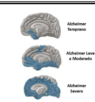 Figura 2. Etapas de la EA. Conforme la EA progresa, los ovillos neurofibrilares se extienden por todo el cerebro 