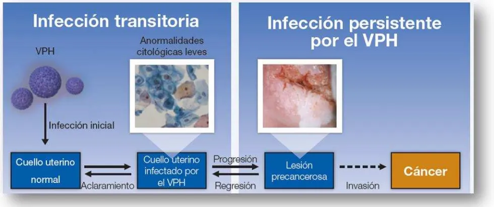 Figura 1. Evolución de la infección causada por el VPH. Se sabe que más del 70% de las adolescentes 