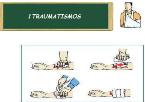 Fig. 3. Tratamiento práctico de una hemorragia leve. Primero cubrir con apósito estéril; si es preciso poner varias gasas