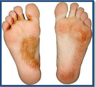 Figura 2. Fotografía de caso clínico común dermatofitosis de pie. (Pie de atleta) 