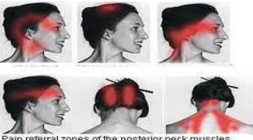 FIGURA 1. Pain referral zones of the posterior neck muscles 