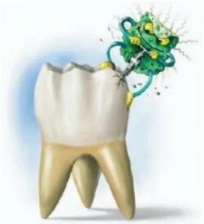 Figura 2. Imagen tomada de   http://unidadodontologicaelcedro.blogspot.com/2010/09/caries.html 