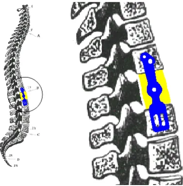 Fig. 5.1b Implante ubicado en la columna vertebral 