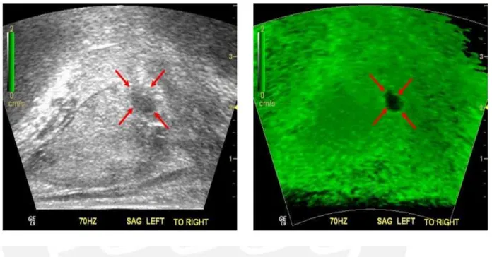 Figure 2.3: (left) B-mode US and (rigth) sonoelastographic images from an in vivo prostatestudy