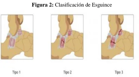 Figura 2: Clasificación de Esguince  