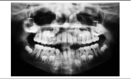 Figure 1. Panoramic radiograph showing a case of bilateral maxillary transposition of canine and first premolar, temporary canine persistence, and agenesis of 32 and 42
