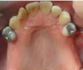 Figura 5. Desinfección total de la boca: raspaje y alisado radicular con curetas de gracey y scaler