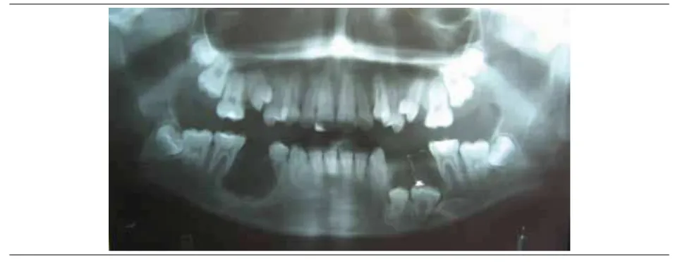 Figura 6. Radiografía panorámica de seguimiento. Defecto óseo en espacio edéntulo de 45 con posibilidad de afectación periodontal de 44 y 46 (flecha).