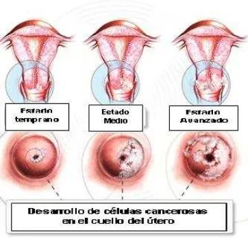 Figura 1.  Lesiones precursoras causadas por el Virus del papiloma humano, que conllevan al desarrollo de Cáncer de cuello uterino