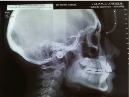 Foto N° 6: Resultado del análisis cefalométrico Steiner de la radiografía #16   