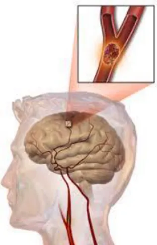 Ilustración 1Accidente cerebro vascular  Elaboración: Juan Bajaña    Fuente: Periódico de salud; 2015 