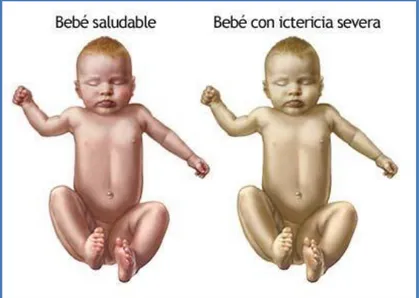 Figura 2 Diferencia entre recién nacido con ictericia. 