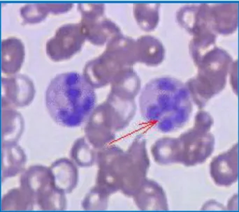 Figura Nº 2.4: Anemia Megaloblástica. 