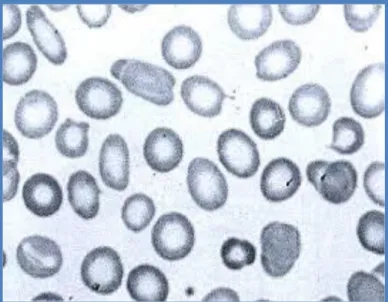 Figura Nº 2.10: Anemia ferropénica . 