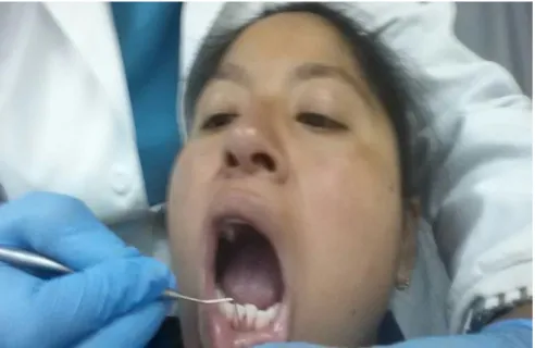 Fig.  10. Sondaje periodontal 