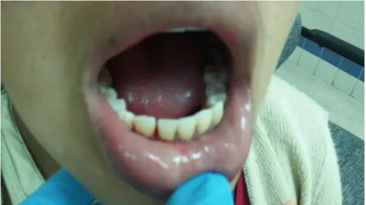Fig.  14  Evaluación gingival de la paciente al momento del sondaje 