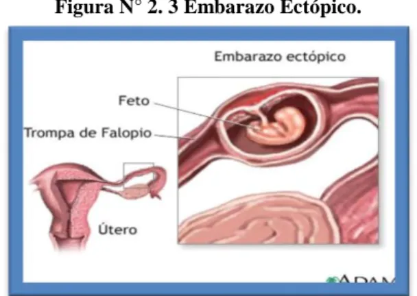 Figura N° 2. 3 Embarazo Ectópico.  